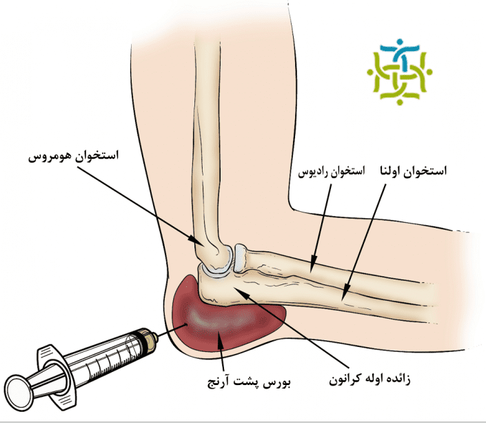 compr_olecranon-bursa-aspiration_figure-1-kh-Recovered compr_olecranon-bursa-aspiration_figure-1-kh-Recovered