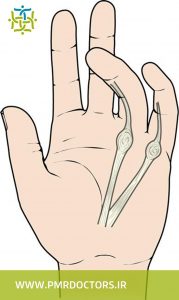کشش و چسبندگی انگشتان در عارضه دوپویترن