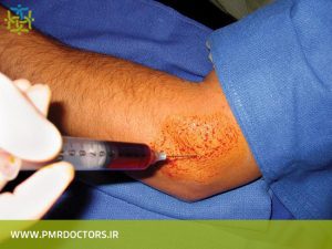 تزریق PRP در درمان اپی کندیلیت خارجی