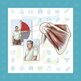 آسیب تاندونهای روتاتور کاف شانه
