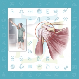 شانه یخ زده تشخیص و درمان