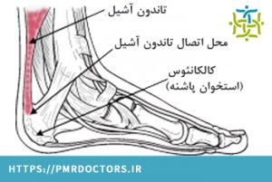 تاندونیت آشیل