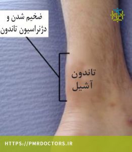 زخیم شدن تاندونیت آشیل