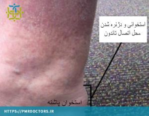 استخوانی شدن محل تاندون آشیل