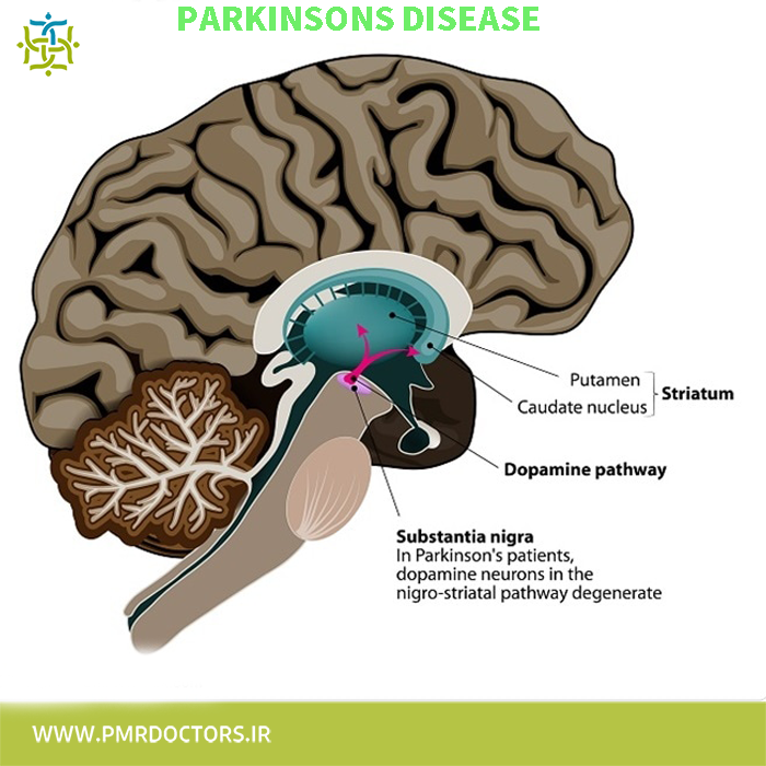 پارکینسون، درمان های توانبخشی، علایم بیمار پارکینسون، علت بیماری پارکینسون ، ورزش در پارکینسون