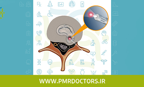 درمان بیرون زدگی دیسک با لیزر
