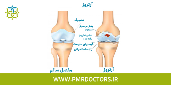 درمان ساییدگی زانو بدون جراحی 