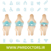 درمان آرتروز زانو بدون عمل جراحی