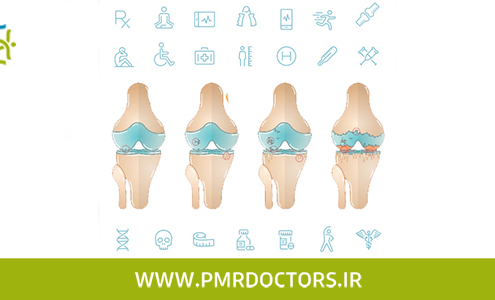 درمان آرتروز زانو بدون عمل جراحی