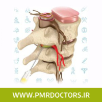 تزریق اپیدورال برای درمان بیرون زدگی دیسک کمر