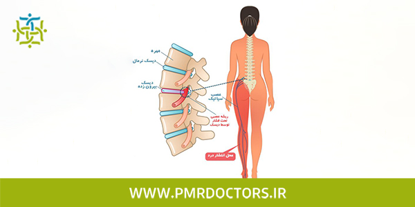 مکانیسم ایجاد درد در عارضه بیرون زدگی دیسک