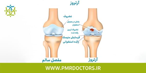 انواع ارتروز