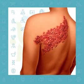 دردهای سوزشی بعد از زونا (نورالژی پست هرپتیک)