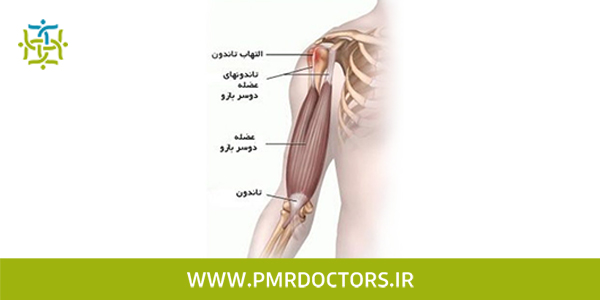 علائم پارگی تاندون شانه