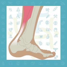 آسیب دیدگی تاندون آشیل