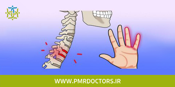 آرتروز مهره های گزدن و مور مور شدن دست