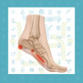 آنچه باید در مورد التهاب فاشیای کف پا یا خار پاشنه بدانید