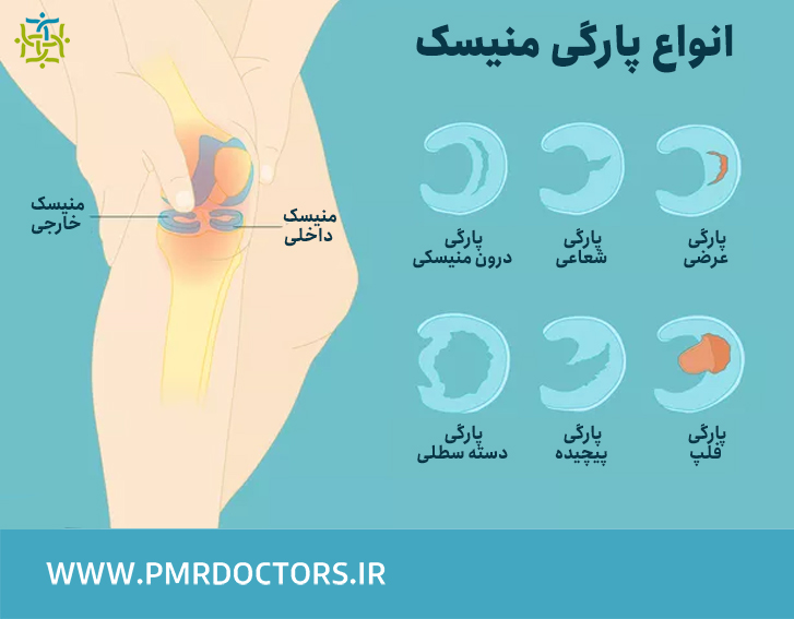 شش نوع پارگی منیسک با هزینه کم