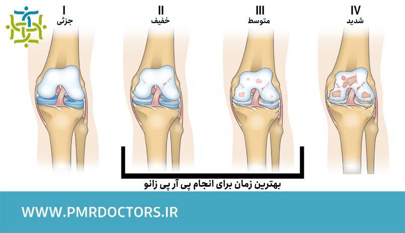 چهار مرحله آرتروز زانو بر اساس شدت و زمان مناسب PRP