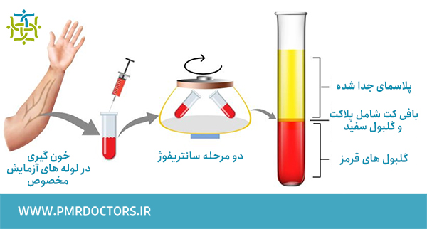 مراحل آماده سازی پی آر پی زانو