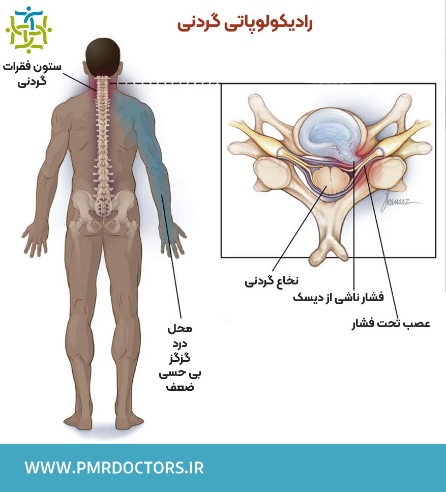 نوار عصب و عضله بیرونزدگی یا فتق دیسک گردن (رادیکولوپاتی گردنی)
