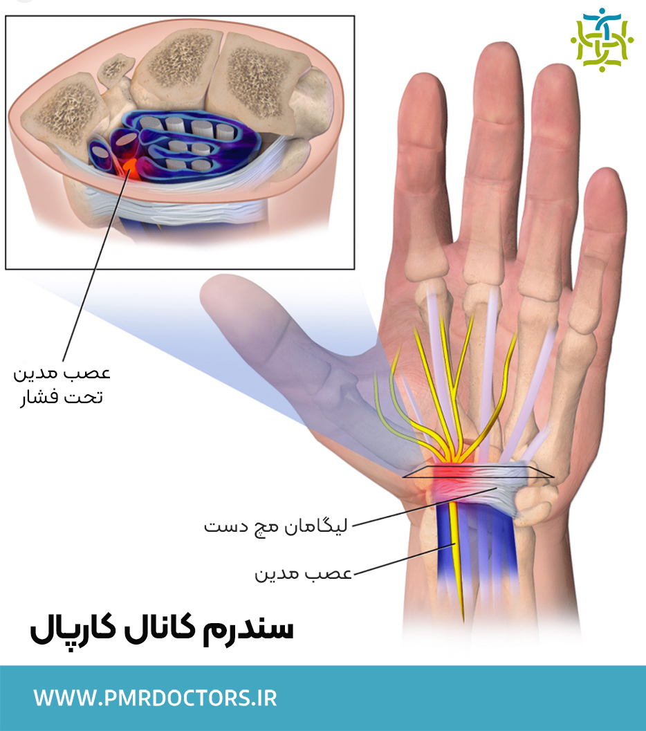 گیرافتادگی عصب مدین در دستگیرافتادگی عصب مدین در دست