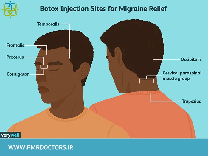 درمان سردرد با تزریق بوتاکس به چه شکلی انجام می‌شود؟