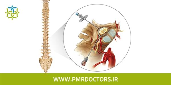 تزریق اپیدورال در درمان غیر جراحی دیسک کمر