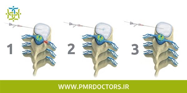 pldd در درمان دیسک کمر بدون جراحی