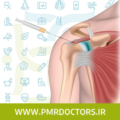 پی آر پی شانه بهترین درمان پارگی تاندون شانه بدون جراحی