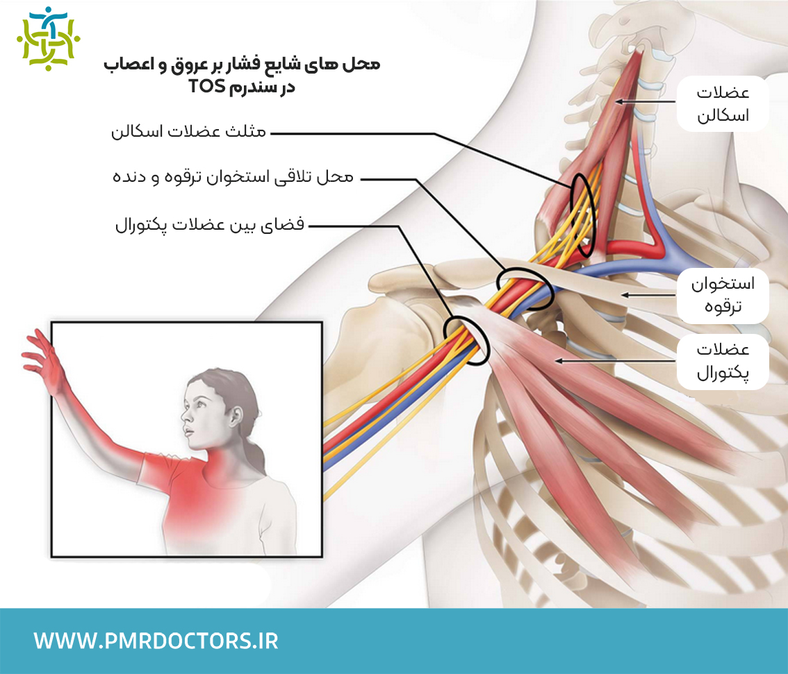 نوار عصب و عضله سندرم دنده گردنی (سندرم خروجی قفسه سینه TOS)