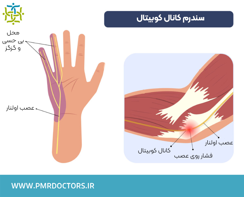 نوار عصب و عضله گیرافتادگی عصب اولنار در آرنج (اولنار نوروپاتی)