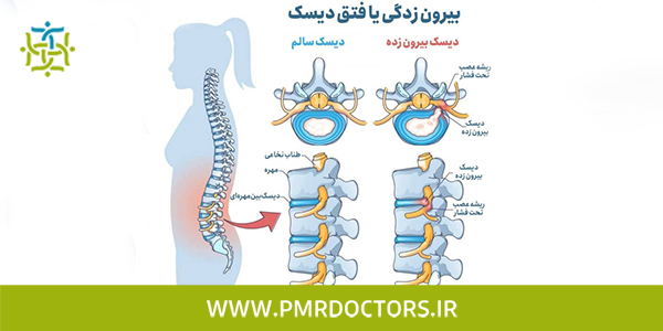 فواید آب درمانی برای دیسک کمر