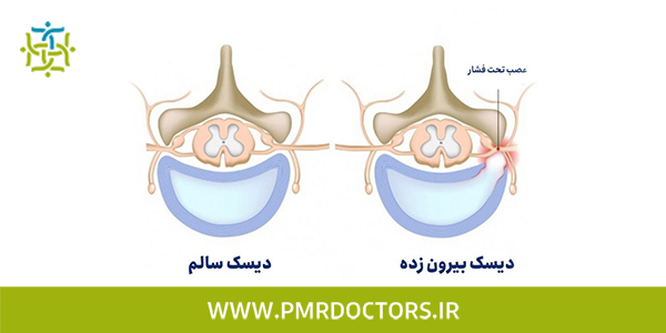 تست نوار عصب و عضله