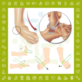 رگ به رگ شدن مچ پا و درمان خانگی پیچ خوردگی با ورزش (تصویری)